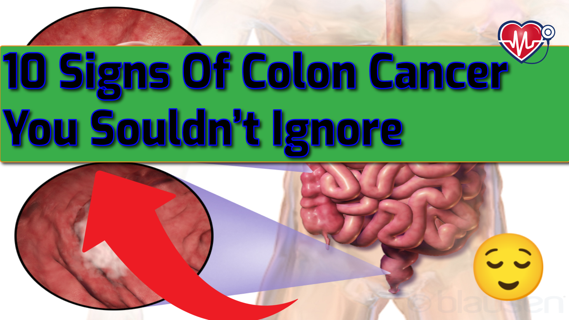 10-warning-signs-of-colon-cancer-you-must-know-essential-health-guide